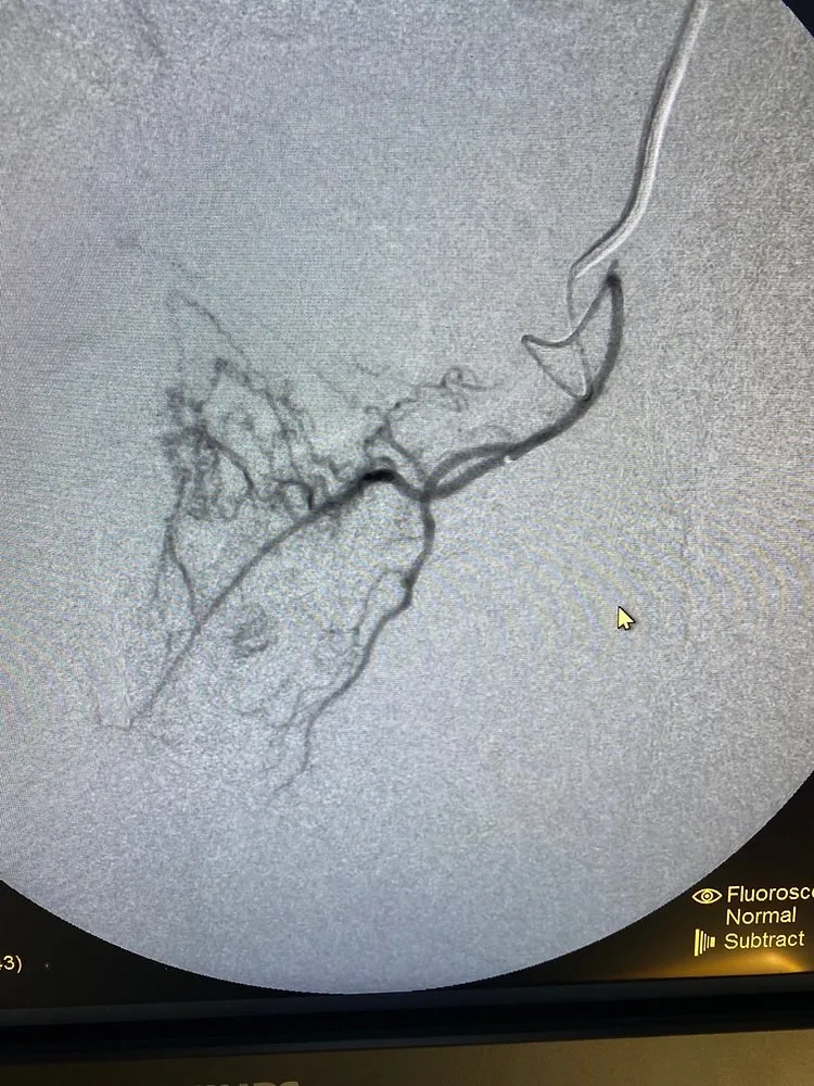 Angiogram of the pelvic arteries
