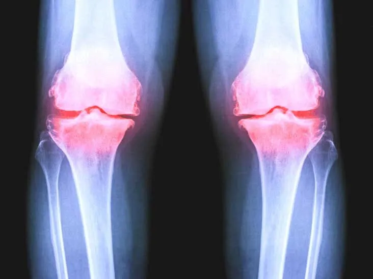 X-ray view of a knee joint